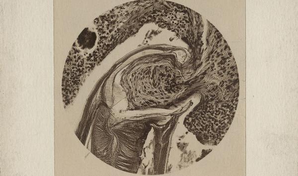 Hookworm (Necator americanus) attached to host. 