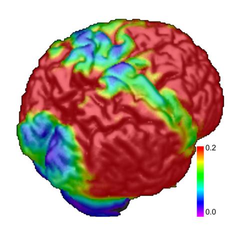 brain imaging showing early stages of Alzheimer's