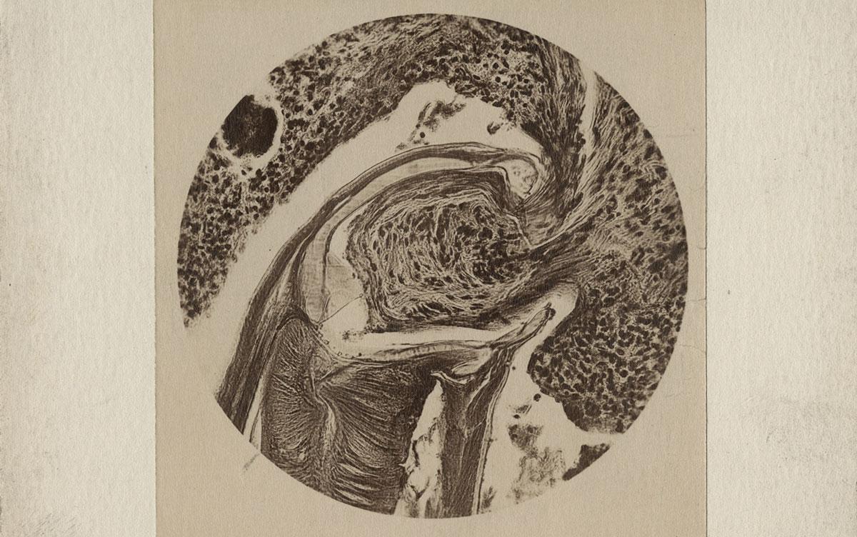 Hookworm (Necator americanus) attached to host.