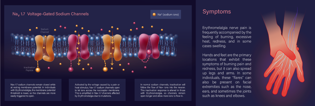 Educational poster with scientific illustrations depicting a medical condition called Erythromelalgia