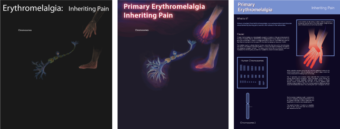 Work in progress of an educational poster design with scientific illustrations depicting a medical condition called Erythromelalgia
