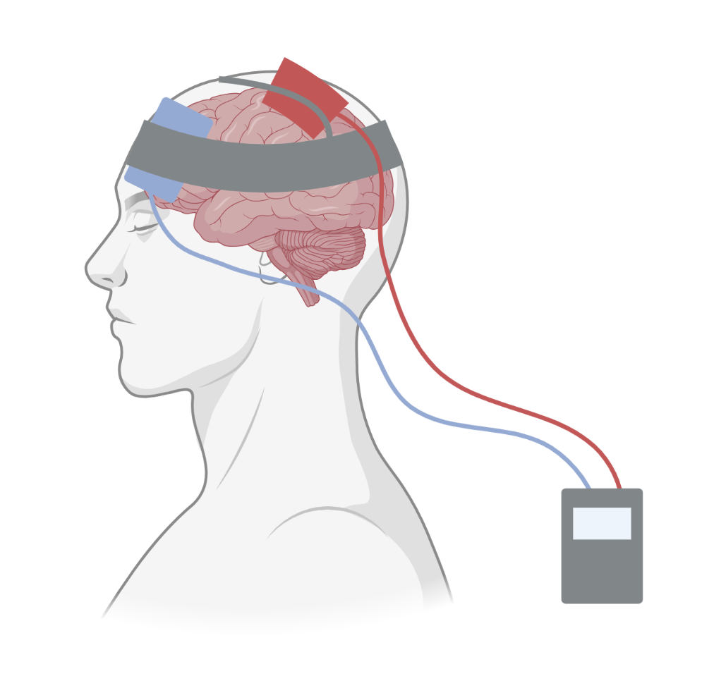 The anode and cathode are held to the head with a fabric band and are attached to a battery pack as a source of electricity.
